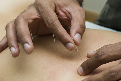 Free Acupuncture