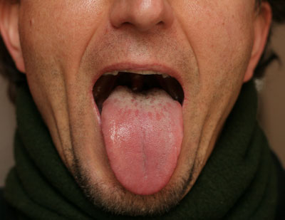 tongue diagnosis