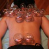 cupping[1]