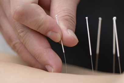 acupuncture 